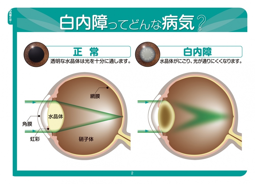 白内障の手術について（多焦点眼内レンズの紹介）｜社会医療法人 慶明