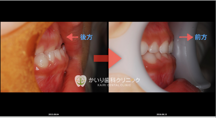矯正症例⑶〜反対咬合改善症例③〜ムーシールド＆パナシールド〜バイオ