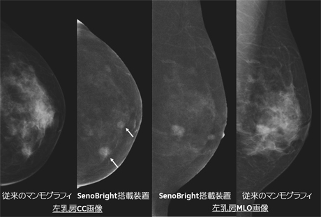GEヘルスケア・ジャパン，国内初の最新マンモグラフィ検査技術