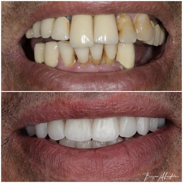 All-on-X and All-on-4 - Middle Tennessee Prosthodontics