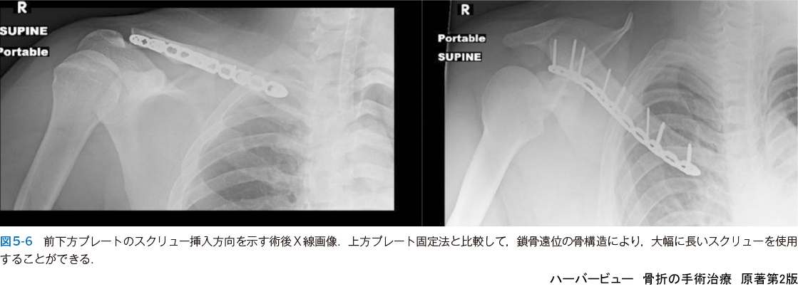 ハーバービュー 骨折の手術治療 原著第2版 - 羊土社