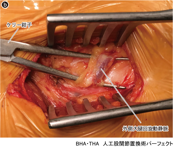 BHA・THA 人工股関節置換術パーフェクト〜人工骨頭置換術・人工股関節