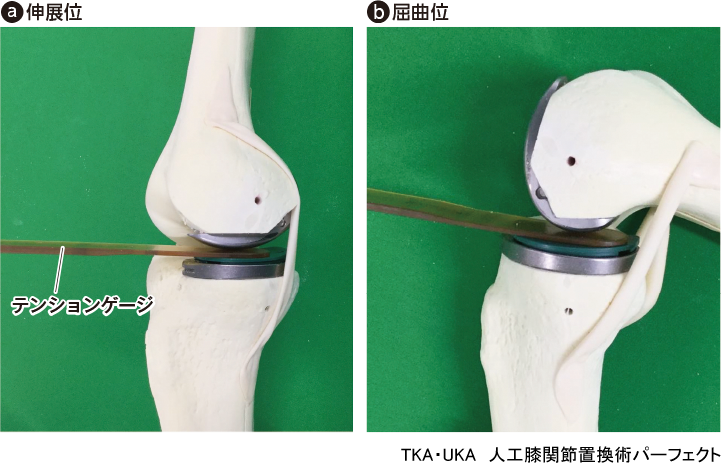 TKA・UKA 人工膝関節置換術パーフェクト〜人工膝関節全置換術・人工膝