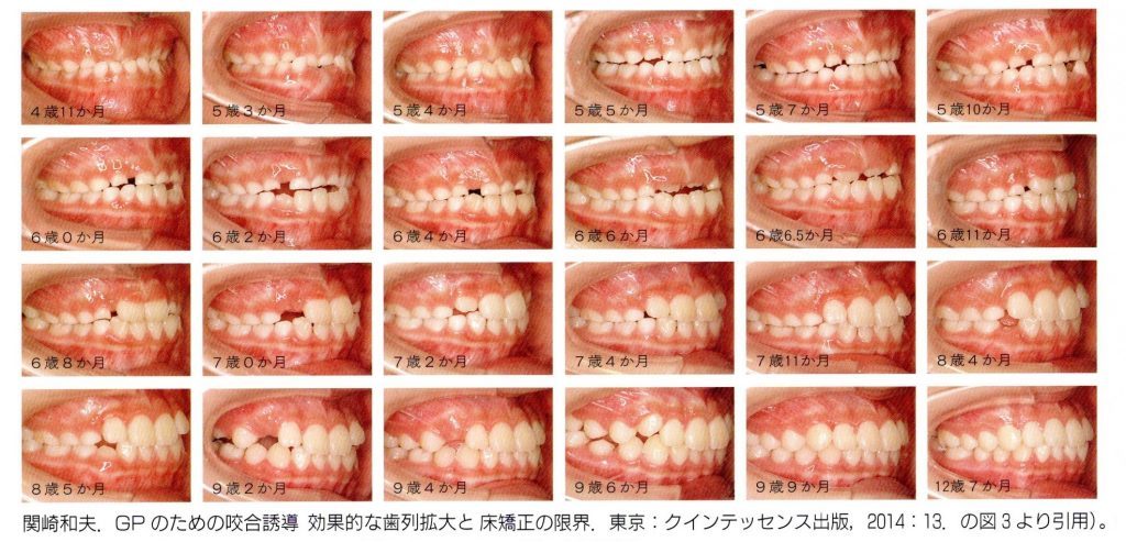 実践 早期治療：咬合誘導から始まる生涯メインテナンス【2】咬合誘導は