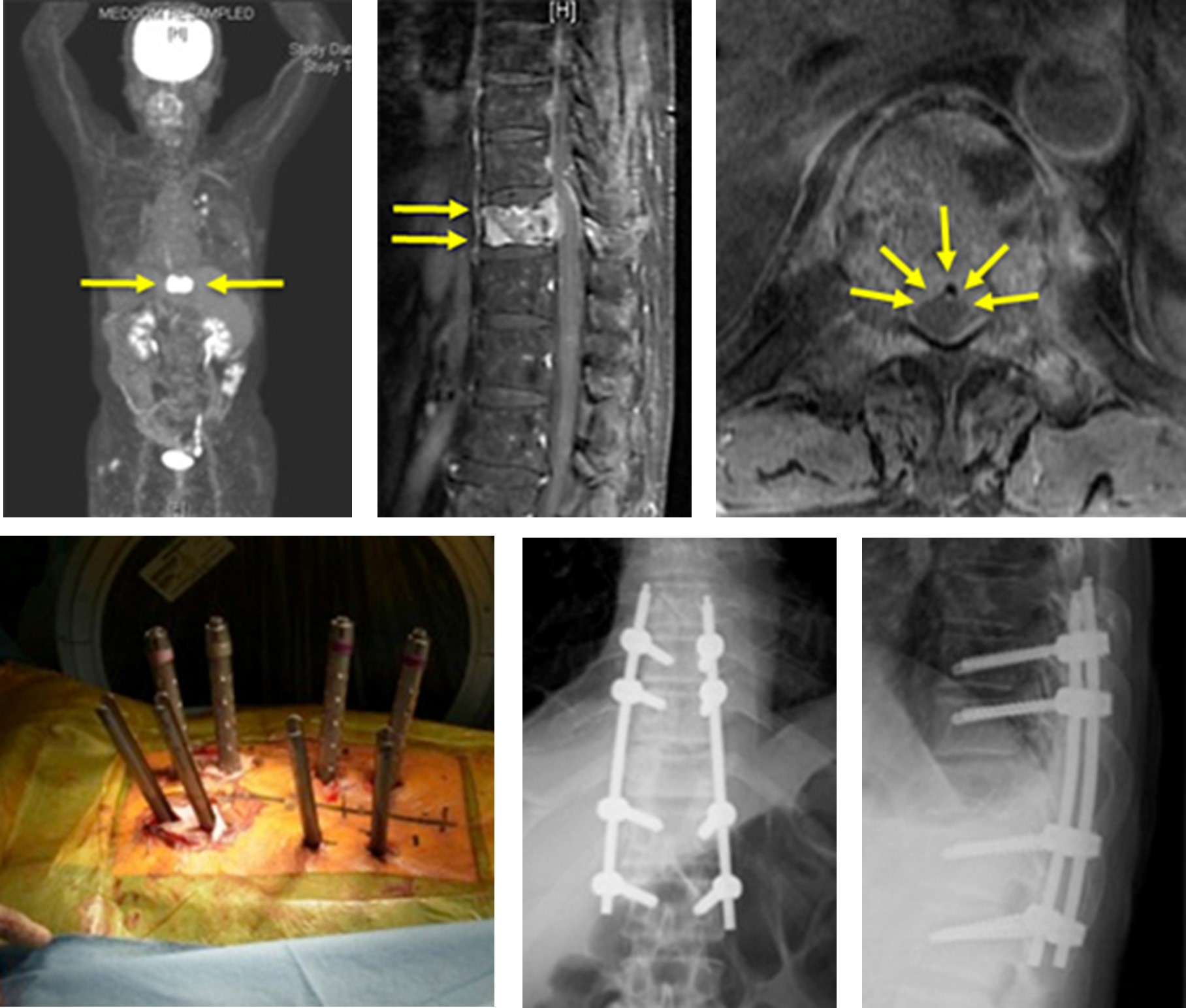 MISt 最小侵襲脊椎安定術（Minimally Invasive spine Stabilization