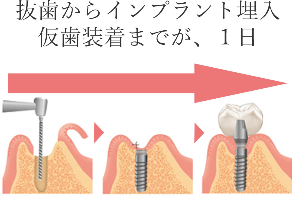 インプラント｜歯科口腔外科｜世田谷区の千歳船橋歯科｜骨再生療法