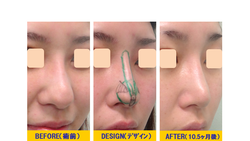 完全クローズ法でダンゴ鼻（下垂型）の解消！ 編 | 美容整形の他院修正