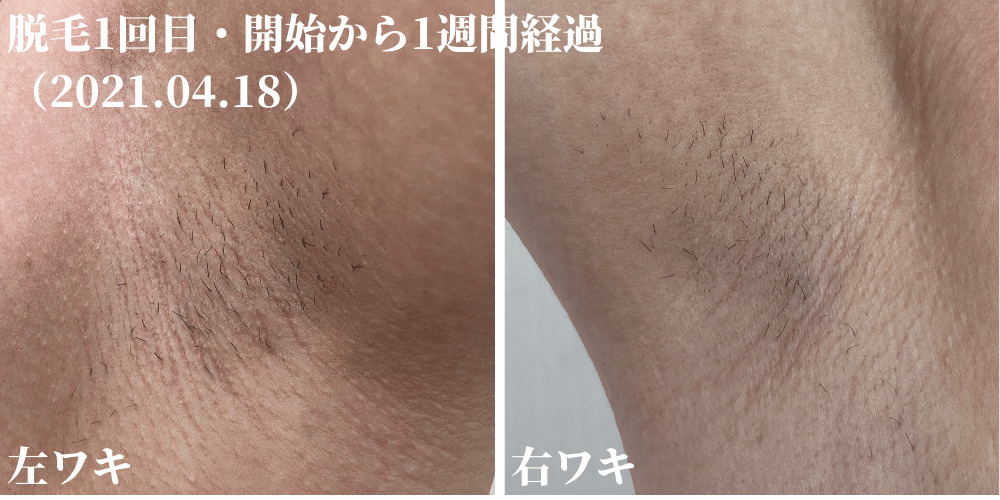 トリアで髭脱毛・痛みや効果をレビュー！3カ月間でどれだけヒゲが減る