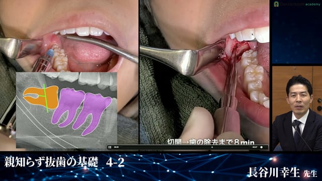 完全版！埋伏抜歯のバイブル | Doctorbook academy (ドクターブック