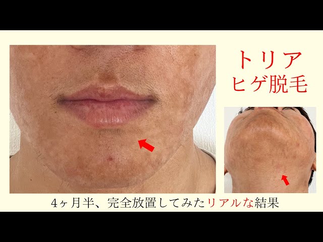 トリア】髭脱毛を4ヶ月半全くしてみなかった結果・・・ヒゲは脱毛後に