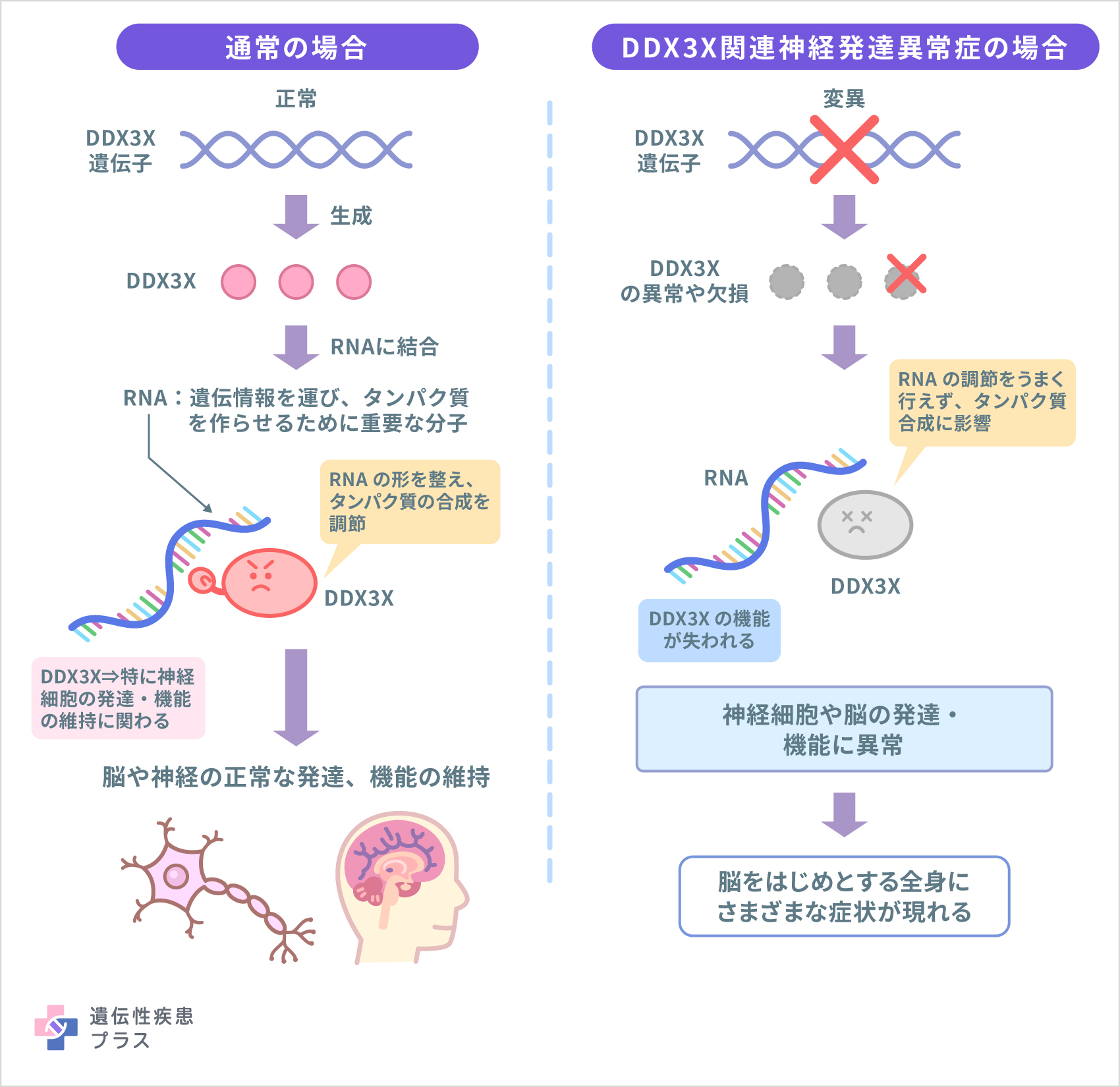 DDX3X関連神経発達異常症 - 遺伝性疾患プラス