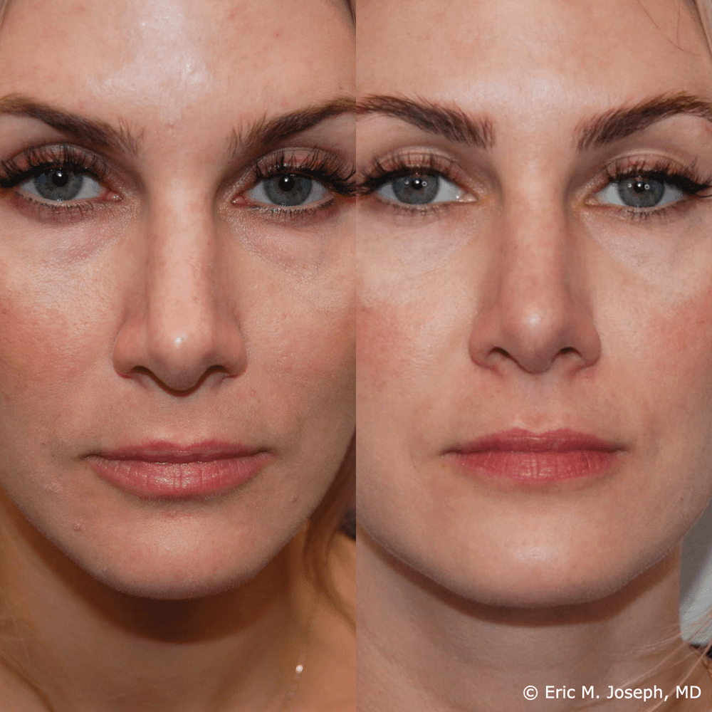 Non-Surgical Rhinoplasty — Eric M. Joseph, MD | Permanent Non