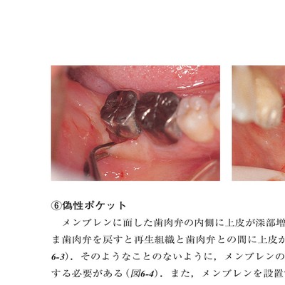 コンセプトを持った予知性の高い歯周外科処置