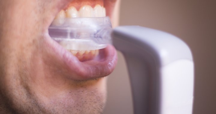 インビザラインの加速装置は効果ある？治療期間を短くする仕組みと