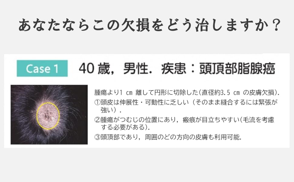 局所皮弁塾 あなたならこの顔の欠損をどう治す？ | 四ッ柳高敏 |本