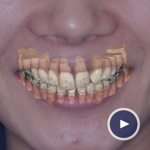 3Dデジタル矯正とは？ | 福岡 矯正歯科｜MOTO矯正歯科福岡 矯正歯科