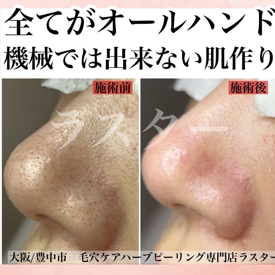 あいうえお様限定】剥離ありハーブピーリング10回分 あいうえお様限定