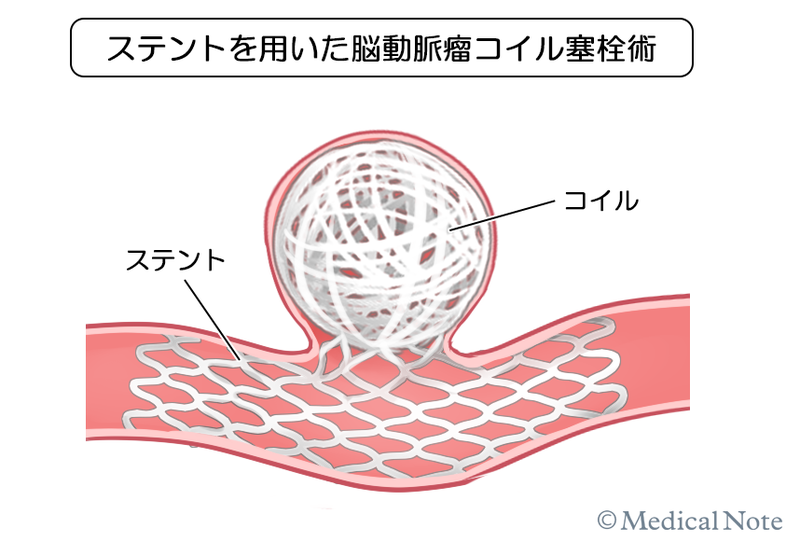 未破裂脳動脈瘤における治療——カテーテル治療を中心に治療内容や治療の